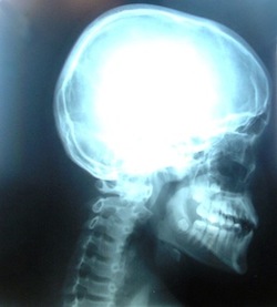 X-ray Head